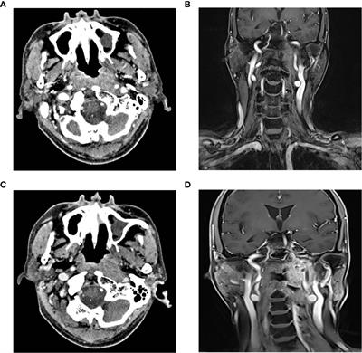 Clinical Outcomes of Salvage Endoscopic Nasopharyngectomy for Patients With Advanced Recurrent Nasopharyngeal Carcinoma